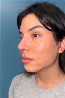 Rhinoplasty After Photo by Jay Xue, MD; Grapevine, TX - Case 51276