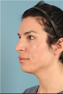 Rhinoplasty Before Photo by Jay Xue, MD; Grapevine, TX - Case 51276