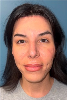 Rhinoplasty After Photo by Jay Xue, MD; Grapevine, TX - Case 51276