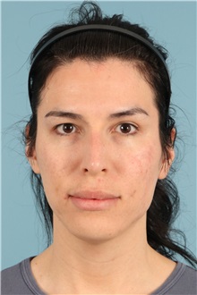 Rhinoplasty Before Photo by Jay Xue, MD; Grapevine, TX - Case 51276