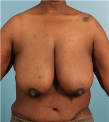Breast Lift Before Photo by Jay Xue, MD; Grapevine, TX - Case 51278
