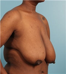 Breast Lift Before Photo by Jay Xue, MD; Grapevine, TX - Case 51278