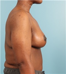 Breast Lift After Photo by Jay Xue, MD; Grapevine, TX - Case 51278