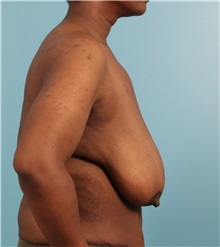 Breast Lift Before Photo by Jay Xue, MD; Grapevine, TX - Case 51278