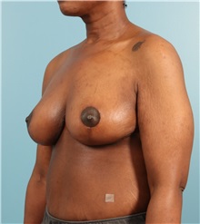 Breast Lift After Photo by Jay Xue, MD; Grapevine, TX - Case 51278