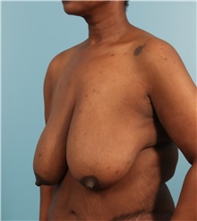 Breast Lift Before Photo by Jay Xue, MD; Grapevine, TX - Case 51278