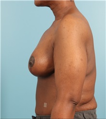 Breast Lift After Photo by Jay Xue, MD; Grapevine, TX - Case 51278