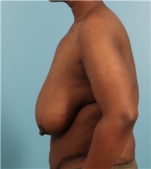 Breast Lift Before Photo by Jay Xue, MD; Grapevine, TX - Case 51278