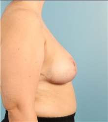 Breast Lift After Photo by Jay Xue, MD; Grapevine, TX - Case 51290