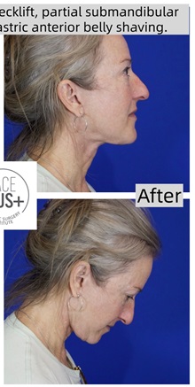 Neck Lift After Photo by Thanapoom Boonipat, MD; Lubbock, TX - Case 50644
