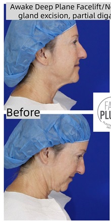 Neck Lift Before Photo by Thanapoom Boonipat, MD; Lubbock, TX - Case 50644