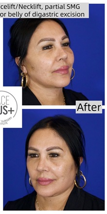 Facelift After Photo by Thanapoom Boonipat, MD; Lubbock, TX - Case 50728