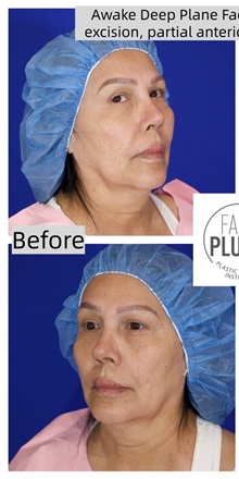 Facelift Before Photo by Thanapoom Boonipat, MD; Lubbock, TX - Case 50728