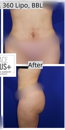 Tummy Tuck After Photo by Thanapoom Boonipat, MD; Lubbock, TX - Case 50772