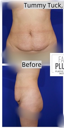 Tummy Tuck Before Photo by Thanapoom Boonipat, MD; Lubbock, TX - Case 50772