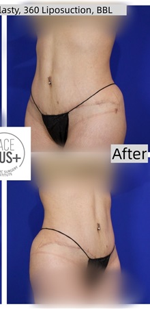 Tummy Tuck After Photo by Thanapoom Boonipat, MD; Lubbock, TX - Case 50772