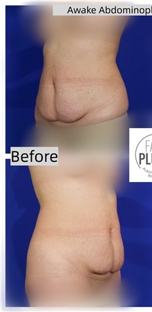 Tummy Tuck Before Photo by Thanapoom Boonipat, MD; Lubbock, TX - Case 50772