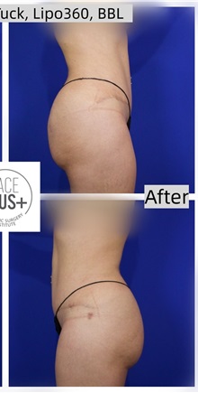 Tummy Tuck After Photo by Thanapoom Boonipat, MD; Lubbock, TX - Case 50772