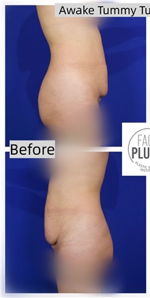 Tummy Tuck Before Photo by Thanapoom Boonipat, MD; Lubbock, TX - Case 50772