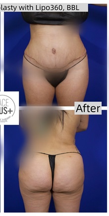 Tummy Tuck After Photo by Thanapoom Boonipat, MD; Lubbock, TX - Case 50773
