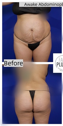 Tummy Tuck Before Photo by Thanapoom Boonipat, MD; Lubbock, TX - Case 50773