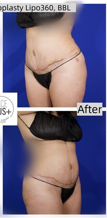 Tummy Tuck After Photo by Thanapoom Boonipat, MD; Lubbock, TX - Case 50773