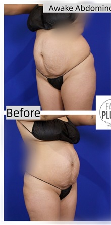 Tummy Tuck Before Photo by Thanapoom Boonipat, MD; Lubbock, TX - Case 50773