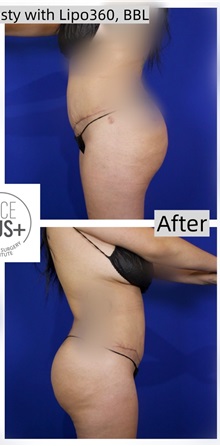 Tummy Tuck After Photo by Thanapoom Boonipat, MD; Lubbock, TX - Case 50773