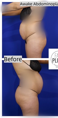 Tummy Tuck Before Photo by Thanapoom Boonipat, MD; Lubbock, TX - Case 50773