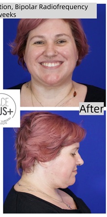 Liposuction After Photo by Thanapoom Boonipat, MD; Lubbock, TX - Case 50776
