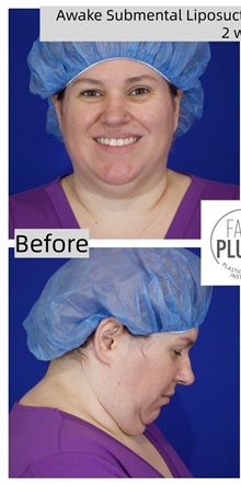 Liposuction Before Photo by Thanapoom Boonipat, MD; Lubbock, TX - Case 50776