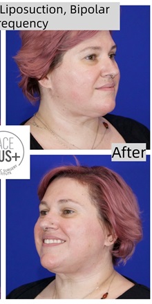 Liposuction After Photo by Thanapoom Boonipat, MD; Lubbock, TX - Case 50776