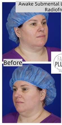 Liposuction Before Photo by Thanapoom Boonipat, MD; Lubbock, TX - Case 50776