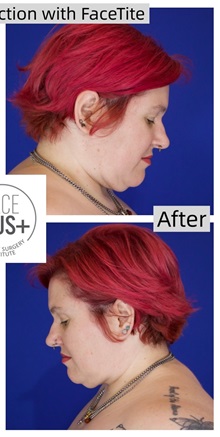 Liposuction After Photo by Thanapoom Boonipat, MD; Lubbock, TX - Case 50776