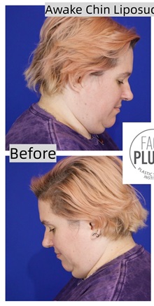 Liposuction Before Photo by Thanapoom Boonipat, MD; Lubbock, TX - Case 50776