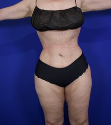 Liposuction After Photo by Thanapoom Boonipat, MD; Lubbock, TX - Case 50820