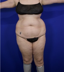 Liposuction Before Photo by Thanapoom Boonipat, MD; Lubbock, TX - Case 50820