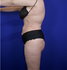Liposuction After Photo by Thanapoom Boonipat, MD; Lubbock, TX - Case 50820