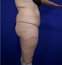 Liposuction Before Photo by Thanapoom Boonipat, MD; Lubbock, TX - Case 50820