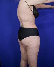 Liposuction After Photo by Thanapoom Boonipat, MD; Lubbock, TX - Case 50820