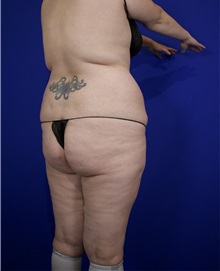 Liposuction Before Photo by Thanapoom Boonipat, MD; Lubbock, TX - Case 50820