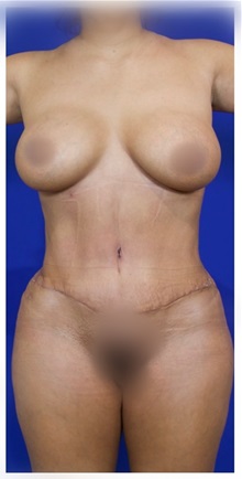 Tummy Tuck After Photo by Thanapoom Boonipat, MD; Lubbock, TX - Case 50821