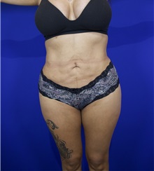 Liposuction After Photo by Thanapoom Boonipat, MD; Lubbock, TX - Case 50849