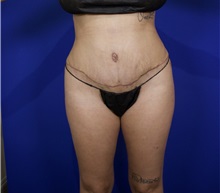 Tummy Tuck After Photo by Thanapoom Boonipat, MD; Lubbock, TX - Case 50848