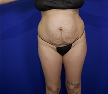 Tummy Tuck Before Photo by Thanapoom Boonipat, MD; Lubbock, TX - Case 50848