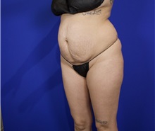Tummy Tuck Before Photo by Thanapoom Boonipat, MD; Lubbock, TX - Case 50848