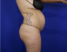 Tummy Tuck Before Photo by Thanapoom Boonipat, MD; Lubbock, TX - Case 50848