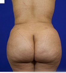 Liposuction After Photo by Thanapoom Boonipat, MD; Lubbock, TX - Case 50858