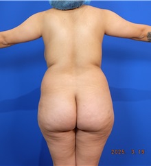 Liposuction Before Photo by Thanapoom Boonipat, MD; Lubbock, TX - Case 50858