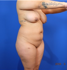 Liposuction Before Photo by Thanapoom Boonipat, MD; Lubbock, TX - Case 50858